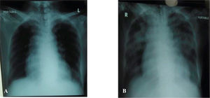 (A), Chest X-ray before transfusion. (B), Chest X-ray after transfusion.