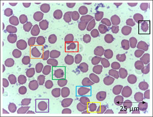 Slide from a critically ill patient with COVID-19 admitted to an intensive care unit of a hospital. The slide details evidence of morphological alterations in red blood cells by the SARS-CoV-2 infection: red - mushroom red blood cells; green - red blood cells with the presence of Heinz bodies; blue - dacryocytes; purple - spherocytes; yellow - echinocytes (plasmolysis), and; black - acanthocytes; orange - keratocytes (bite cell). Staining method: Leishman. Magnification: 400X. Credits: Dr. Denise da Silva Pinheiro - LACES-ICB UFG.