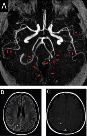 Brain magnetic resonance and angiography images. A, Angiography MRI showing segmental arterial constriction (red arrows). B, High intensity signal in the cortical sulcus and gyrus of the right parieto-occipital convexity on T2/Flair (white arrowheads). C, Slight impregnation of contrast in the leptomeningeal adjacent to the right parieto-occipital convexity on T1-GD (white arrowheads).