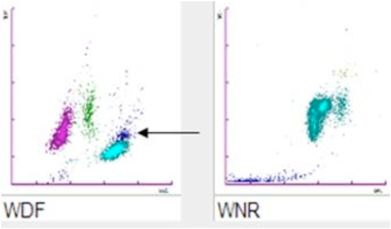 Wdf Scaterrogram Unusual leukoagglutination: A rare haematological finding | Hematology ...