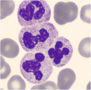 Granulocytes aggregates on the blood smear.