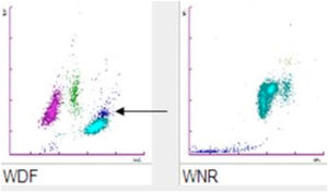 Scattergram patterns of the WBC count in the WDF and WNR Channel. The arrow indicates the atypical cloud probably generated by some of the aggregates.