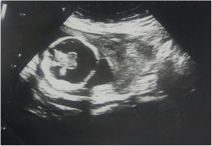 Evidence of holoprosencephaly from scan.