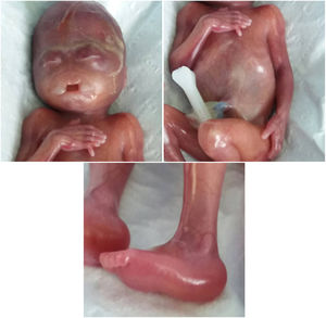 Fetus with normal single cord but complicated with hypotelorism, mid-facial deformity, absence of nasal bone, cleft lip and palate, polydactily and rocker-bottom feet.