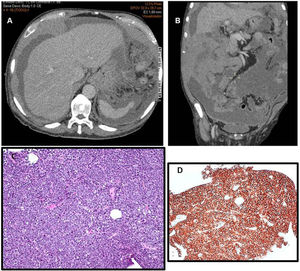 (A and B) Thoracic-abdominal-pelvic computerized tomography (CT), axial image (1A), and coronal (1B). Abundant ascites is observed with marked thickening in the lesser omentum and peritoneum. No lymphadenopathy was observed. (C) Histological confirmation of peritoneal lymphomatosis. The core-biopsy shows a diffuse monomorphic proliferation of medium and large lymphoid cells centroblastic-like (Hematoxylin–Eosin, 400×). (D) The CD20 expression by immunohistochemistry (200×).