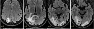 Cranial NMR showing lesions in both occipital lobe, right parietal lobe and right subinsular region, extending to corpus callosum, temporal isthmus and right geniculate body.