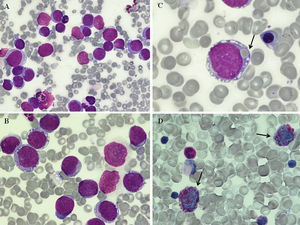 (A-B) Bone marrow aspirate smear showing diffuse infiltration by blast-like cells (May Grunwald Giemsa (MGG) stain, 60 ×, 100x). (C) Erythrophagocytosis by neoplastic cells (black arrows; MGG stain, 100 ×). (D) Block-like cytoplasmic pattern in neoplastic cells (black arrows; Periodic Acid-Schiff (PAS) stain, 100x).