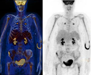 18F-FDG-PET/CT revealing an increased bone marrow uptake in axial skeleton and in both humerus and femurs, as well as a very increased bone marrow uptake in iliac crest of the right ilium.