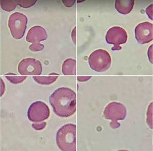 Pincer cells in a patient with chronic kidney disease and diagnosed with COVID-19.