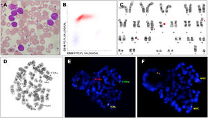 A: peripheral smear (original × 1000; Leishman stain); B: blasts in red and T-lymphocytes in blue by flow cytometry; C: conventional karyotype, G-banding; D and E: metaphasic FISH with TCRAD dual-color break-apart probe; F: metaphasic FISH with MYC dual-color break-apart probe. Note that D, E and F represent the same metaphase and the 5′ signal of TCRAD (Figure 1E) is located near the position of MYC gene in Figure 1F, suggesting TCRAD-MYC translocation. (For interpretation of the references to colour in this figure legend, the reader is referred to the web version of this article.)