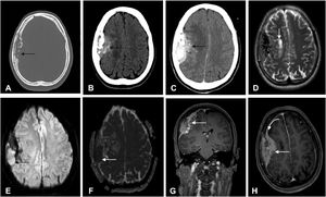Axial CT images with bone (A) and soft (B) windows (B, without contrast and C with contrast) demonstrates a bone lesion with lytic permeative pattern extending to the epidural space and brain parenchyma.  On MRI, the lesion demonstrates low T2 signal on axial (D) and there is also parenchymal involvement in the right frontal lobe. Diffusion was restricted (with hyperintensity on DWI, in E, arrow; and low intensity on ADC map in F, arrow). The lesion exhibits heterogeneous enhancement; coronal T1-weighted (G) and axial (H) after contrast administration.