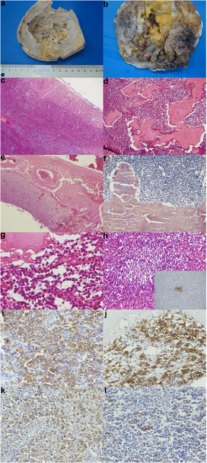 (a) Skull cap section showing irregularities caused by tumor compression on the inner face (b) Section of dura mater showing large tumor deposits (c) A diffuse, atypical lymphoid infiltrate in the dura mater - Hematoxilin-eosin (HE), 25X (original magnification) (d) A dense lymphoid infiltrate with abundant amyloid deposits - HE, 40X (original magnification) (e) Thickening of leptomeninges by the amyloid deposits - HE, 40X (original magnification) (f) The amyloid material was congo red positive - HE, 100X (original magnification) (g) A monotonous atypical lymphoid infiltrate, with extensive amyloid deposition - HE, 400X (original magnification) (h) A monotonous atypical infiltrate, with a residual germinal center - HE, 200X (original magnification) - Inset: detection of CD23 by immunohistochemistry, highlighting dendritic follicular cells within the residual germinal center - Immunoperoxidase, 200x, (original magnification) (i) Detection of CD20 (a B cell marker) by immunohistochemistry: diffuse positivity in neoplastic cells - Immunoperoxidase, 400x (original magnification) (j) Detection of CD138 (a plasma cell marker) by immunohistochemistry: diffuse positivity in neoplastic cells and reactive plasma cells - Immunoperoxidase, 400x (original magnification) (k) Detection of kappa immunoglobulin light chain by immunohistochemistry: diffuse positivity in neoplastic cells - Immunoperoxidase, 400x (original magnification) (l) Lack of positivity for lambda immunoglobulin light chain in neoplastic cell: internal positive control is provided by sparse reactive plasma cells (400x).