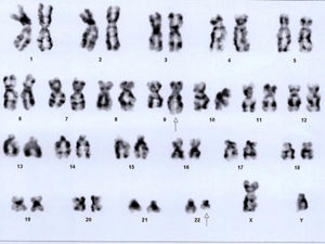 Bone marrow cytogenetics showing translocation between chromosomes 9q34 and 22q11.2, resulting in Philadelphia chromosome. Number of cells counted: 20; Number of cells analyzed: 20; Number of cells karyogramed: 12; Banding methods: GTG Banding. Result: 46,XY,t(9;22)(q34;q11.2)[20].