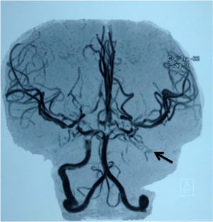 Magnetic resonance angiography in the child #6 (Table 2), showing occlusion of the left internal carotid artery (arrow).