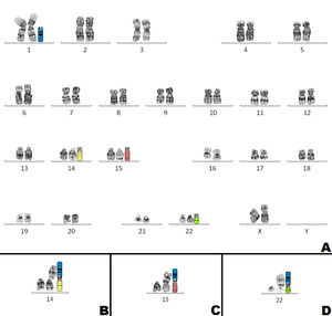 A-G- banding Karyotype, showing ideogram of 1q in blue, 14q in yellow, 15q in red and 22q in green. B-Partial Karyotype with normal chromosome 14, der(14)t(1;14)(q12;p11.2) and schematic model blue/yellow of der(14). C- Partial Karyotype with normal chromosome 15, der(15)t(1;15)(q12;p11.2) and schematic model blue/red of der(15). D- Partial Karyotype with normal chromosome 22, der(22)t(1;22)(q12;p11.2) and schematic model blue/green of der(22).