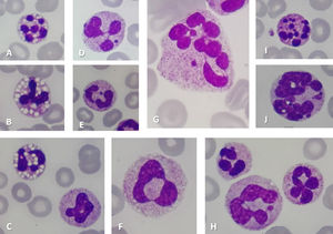 Neutrophils with vacuolation (Images A, B, C) or Howell-Jolly Body-like inclusions (Images D, E) or ring nucleus shape (Images C, F), Macropolycytes (Images F, G, H, J), Macropolycytes with Howell-Jolly Body-like inclusions (Image G), Apoptotic neutrophils/macropolycytes (Images I, J) (May-Grünwald-Giemsa stain, original magnification x1000).