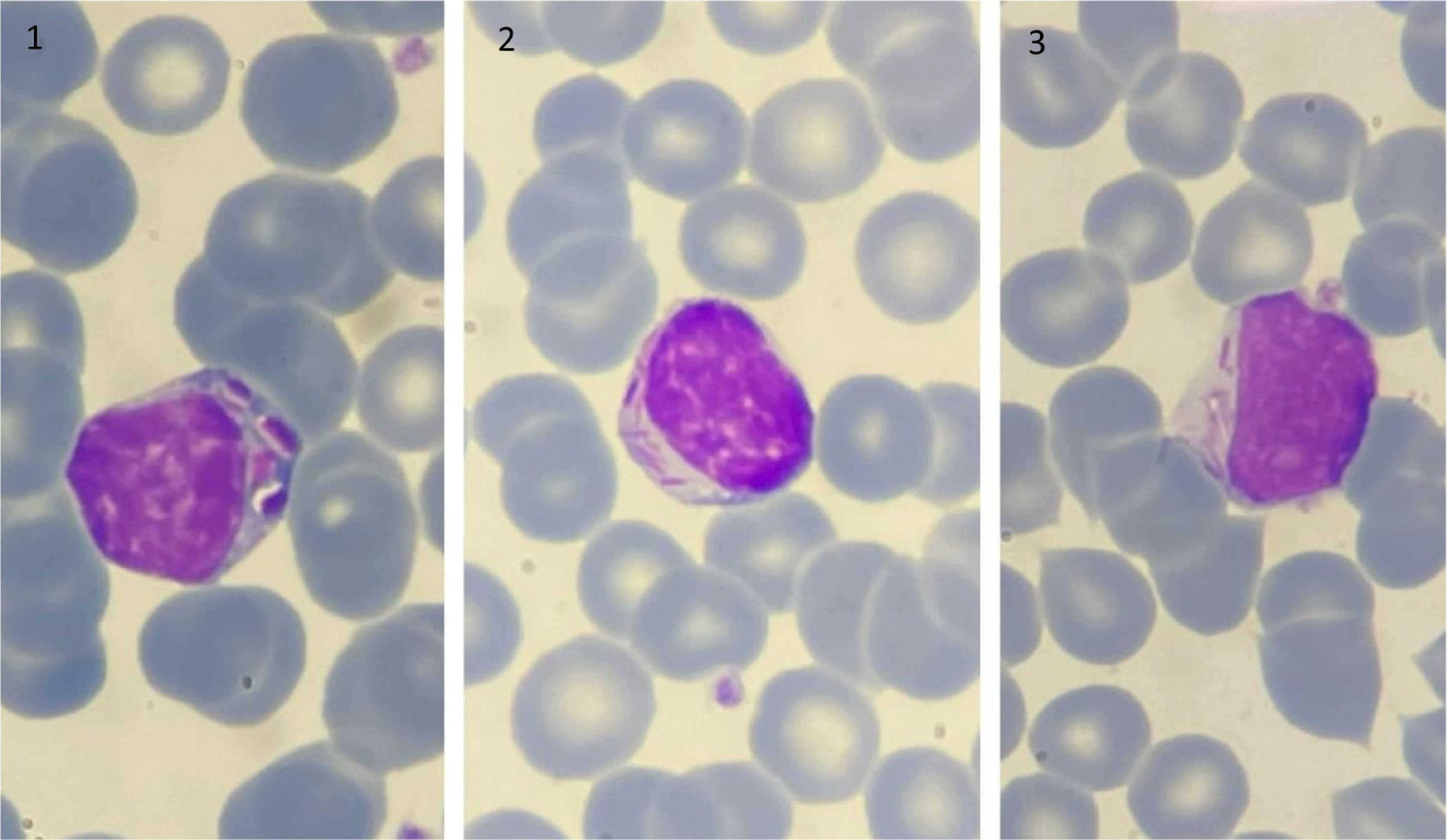 Lymphocytes with auer rod-like inclusions in chronic lymphocytic ...