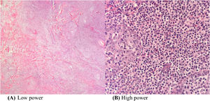 (A, B) A wedge biopsy from the face shows presence of epidermotropism and malignant cells are described as diffuse small monomorphic lymphocyte infiltrates with cerebriform nuclei.
