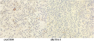 (A-B) Neoplastic cells show negativity for CD30 and TIA-1.