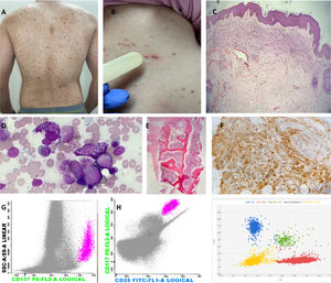 Images representing major and minor WHO criteria for the diagnosis of SM and cutaneous involvement. (A) Red–brownish maculopapular cutaneous lesions, monomorphic type (formerly known as urticaria pigmentosa) in patients with ISM. (B) Positive Darier's sign – A wheal-and-flare reaction develops upon stroking of a CM lesion with a tongue spatula. (C) The dermal cellular infiltrate consists predominantly of mast cells associated with vascular congestion and mild fibroplasia (H&E, 40x). (D) Bone marrow (BM) aspirate – anomalous hypogranular and spindle-shaped mast cells (Leishman, 200x). (E) BM biopsy – global hypercellularity (95%), extensive infiltration by mast cells. Bone BM trabeculae without significant histological changes (H&E, 200x). (F) Immunohistochemistry of BM shows a large mast cell burden (CD117 immunostaining counterstained with Harris hematoxylin, 400x). (G) Flow cytometry of BM cells shows anomalous CD25+ mast cells (pink dots); mast cells are identified through CD117 positivity and the high internal complexity of the cells, anomalous phenotype CD117+/CD25+. (H) Digital PCR (peripheral blood analysis) for the D816V mutation. Red represents the wild-type codon and blue represents the D816V mutation. Two copies are represented together in green (wild-type and mutated); the yellow color represents the absence of the studied gene.