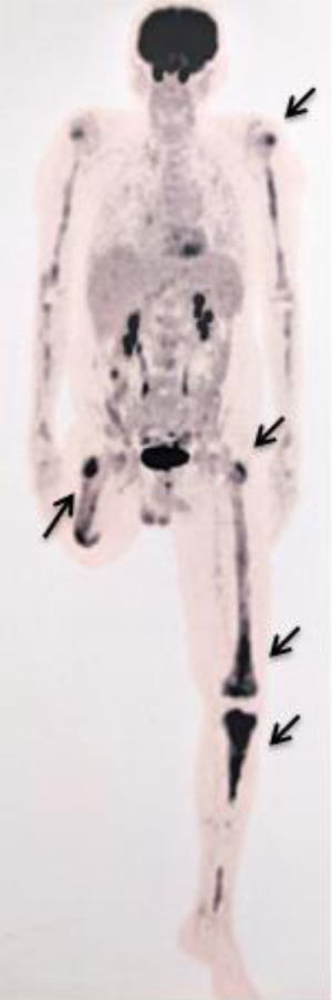 18FFDG–PET Scan with bone inflammatory lesions (black arrows).