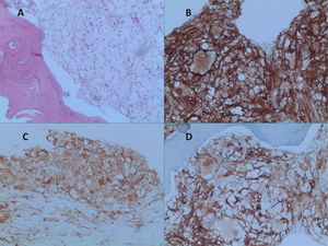 HE and immunohistochemistry analysis of bone biopsy: Xanthogranulomatous histiocytes infiltration CD 68 (B), CD163 (C), and Factor XIII (D) positive. Denditric markers (CD1a, S100) were negative (data not shown).