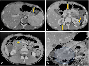 Axial (A, B, C) and coronal (D) contrast enhanced CT scans of abdomen. Well defined hypodense lesions seen in the tail and neck region of pancreas (arrows in ‘A’ and ‘B’) without any obvious evidence of mass effect. Similar lesions are noted at upper pole regions of both the kidneys (arrow in ‘C’).There is a large hypodense mass lesion in upper retroperitoneum with loss of fat planes with head of pancreas (star in ‘C ‘and marked in ‘D’). Patient also had hepatosplenomegaly. Radiological differential of lymphoma likely Non Hodgkin type was suggested.