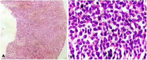 A. CT guided Core biopsy from the pancreatic mass was showing a small round cell tumour arranged in diffused sheet (H & E 40X). B. On higher power the tumour cells had round to convoluted nuclei, dense chromatin, inconspicuous nucleoli and scant basophilic cytoplasm.