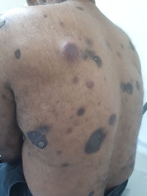Patient with tumoral and hyperchromatic cutaneous lesions, some with necrosis central and secretion.