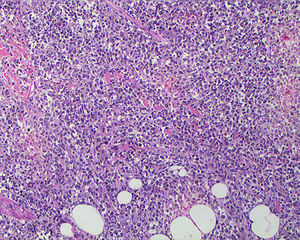 Skin with diffuse interstitial infiltrate of lymphoid cells. HE:100x.