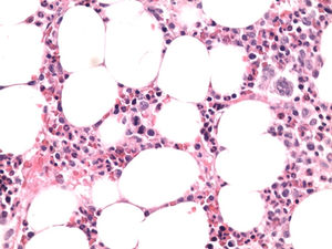 Bone marrow biopsy. Large lymphoma cells fill the sinuses of the bone marrow. Hematoxylin and eosin 400x.