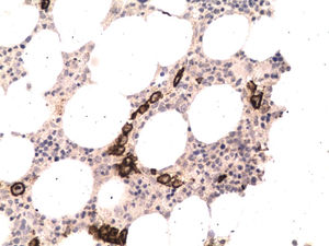 CD20 staining highlights the large B-cells in the lumen of the vessels.