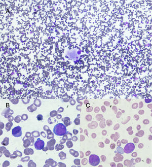 Bone marrow aspirate with May Grünwald Giemsa stain. A) 10x shows normocellular bone marrow with dysplastic megakaryocyte. B and C show in 100x large cells with high nuclear cytoplasmatic ratio, large nucleus with evident nucleoli these cells (blast cells) represent 12% of nucleated cells.