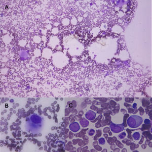 Bone marrow aspirate with May Grünwald Giemsa stain. A) 10x shows normocellular bone marrow with numerous dysplastic megakaryocytes. B) shows in 100x a dysplastic megakaryocyte. C shows in 100x granular dysplasia with hipogranulation, and large cells with high nuclear cytoplasmatic ratio, large nucleus and evident nucleoli (blast cells) these cells represent 3% of nucleated cells.