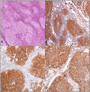 A. Parotis gland involved by follicular lymphoma composed of homogeneus nodules (H&E,X40) B. Tumor cells of follicular lymphoma showed positivity for immunohistochemistry of CD20 (CD20/peroxidase stain,X40) C. Bcl-2 (Bcl-2/peroxidase stain,X40) D. CD10 (CD10/peroxidase stain,X40).