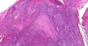 Follicular lymphoma and Langerhans cell histiocytosis shown within the same tissue (H&E, X40).