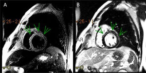 A, Triple IR image on short axis showing anterior wall edema (arrows). B, Delayed enhancement image on short axis showing extensive mesocardial late enhancement in the anterior wall in accordance with the edema area (arrows).