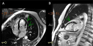 Delayed enhancement image on 4 chambers (A) and 2 chambers (B) showing subepicardial and mesocardial areas of late enhancement in the lateral and anterior walls (arrows).