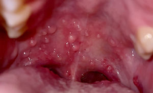 Multiple translucent vesicles with inflammation on soft palate consistent with superficial mucoceles.