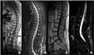 MRI showing an intramedular lesion, with contrast enhancement focused in the conus medullaris (A) and patched hyperintense areas up to D10 vertebral body in STIR (B) sequence. Post-treatment images show no contrast enhancement (C) nor STIR abnormalities (D).