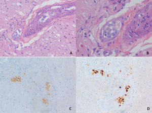 Hematoxylin-eosin staining of a biopsy sampling demonstraiting a blood vessel lumen filled with large cells of round and oval-shaped nuclei, prominent nucleoli and scant to moderate cytoplasm (A, B). These cells express typical B-cell markers as CD-20 (C) and also proliferation markers as Ki-67 (D).