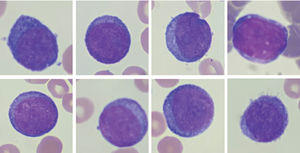 Peripheral blood smear. Proerythroblasts; panel A-H: erythroid progenitors having large irregular nuclei, dispersed chromatin, some with prominent nucleoli, deeply basophilic cytoplasm, and high nuclear to cytoplasmic ratios. Wright stain; 100X objective, original magnification X1000.