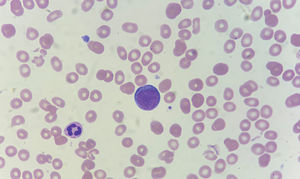 Proerytroblast in peripheral blood smear. Wright stain; 100X objective, original magnification X1000.