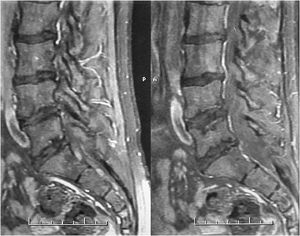 Magnetic resonance imaging of the lumbosacral spine in sagittal section showing signs of microfractures in the plateaus of the lumbar vertebral bodies. Finding typically related to avascular necrosis.