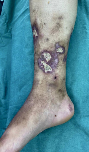 Medial face of right leg.