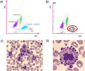 Incidental finding of platelet sattelitism upon blood smear review. Normal peripheral blood scattergram (A). Abnormal White Blood Cell scattergram flag on the Sysmex Cell counter; the grey cloud with red circle represents the abnormal white blood cells (b). Platelet sattelitism with clustering of neutrophils (c). Close-up of a neutrophil surrounded by platelets (d). SFL: Side Fluorescence Light; SSC: Sideward Scatter; MONO: monocytes; LYMPH: lymphocytes; NEUT + BASO: Neutrophils + Basophils; EO: Eosinophils.