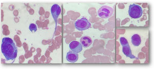Bone marrow aspirate and peripheral blood smear revealing large size plasma cells with nuclearpleomorphism, some presenting convoluted nuclei, some binucleated (Leishman x 1000)