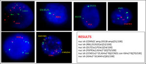 Multiple Myeloma interphasic FISH panel - CD138+ cells (according to Kishimoto, 20167) A. many red (CDKN2A) and green (CKS1B) signals, compatible with amplification CKS1B and CDKN2A genes; B. one red (RB1) and one green (D13S25) signal, compatible with deletion/monosomy 13; C. two green (centromere 7) and 1 red signal (P53) compatible with P53 deletion; D. 2 red (FGFR3) and many green (IGH) signals; E 2 red (MAF) and many red (IGH) signals; F: many red (CCND1) and green (IGH) fusion signals compatible with CCND1-IGH fusion amplification. Cut-off levels according to European Myeloma Network (EMN) guideline published in 2012: 10% for fusion or breakapart probes [t(4;14); t(11;14); t(14;16)], and 20% for numerical abnormalities [gain or deletion of CK1SB, CDKN2C (chromosome 1), TP53 (17p) and RB1 (13q)].8