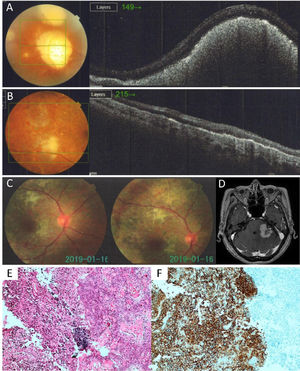 (A) OD OCT before treatment showing an elevated subretinal lesion; (B) OD OCT after treatment showing a size reduction of subretinal lesion; (C) Retinography showing a macula with decreased brightness, vessels tortuosity, retinal pigment epithelium moderately atrophic with areas of retinal hypopigmentation and isolated microhemorrhages; (D) Brain MRI with a 3 cm expansive lesion in the left cerebellar hemisphere; (E) Hematoxylin and eosin stain of the brain biopsy reveals a diffuse infiltrate of lymphocytes in the left half of the figure. The right half shows the angiomatous meningioma. (F) Immunohistochemistry positive for CD20 marker.