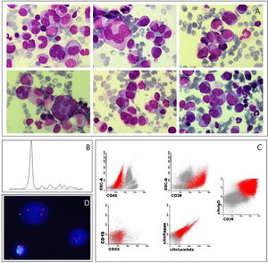 A. Bone marrow smear showing atypical plasma cells: giant mutilobated, with cleaved nuclei and with evident nucleoli (May-Grünwald-Giemsa stain, x1000). B. Serum protein electrophoresis. C. Bone marrow flow cytometry study showing in red the clonal plasma cells phenotype. D. Interphase fluorescence in situ hybridization showing 1p deletion and 1q gain.